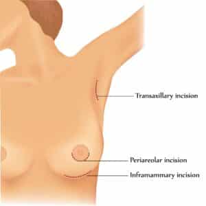 Diagram showing the location of the different breast augmentation incisions, Savannah, GA