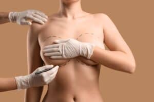 Plastic surgeon marking woman's breasts to prepare for breast augmentation